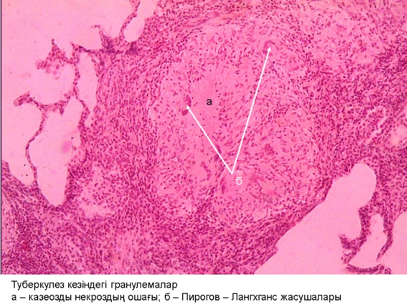 Туберкулез кезіндегі гранулемалар а – казеозды некроздың ошағы; б – Пирогов – Лангхганс жасушалары